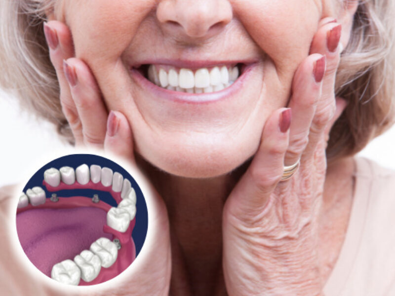 dentalin overdenture